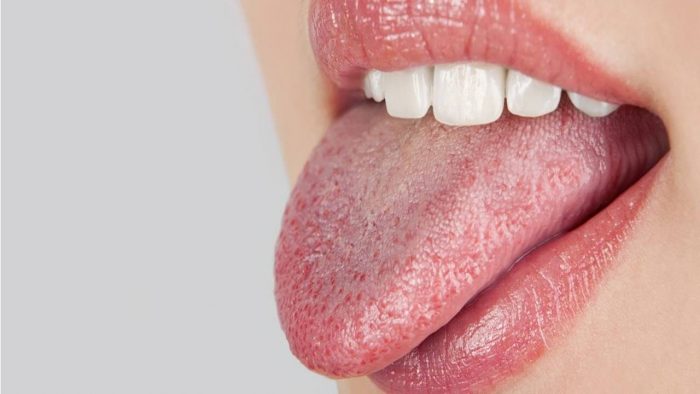 How to Get Rid of Dry Mouth Naturally