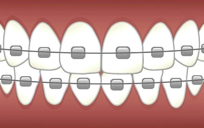 5 Preventive Measures to Take After Attaching Teeth Braces